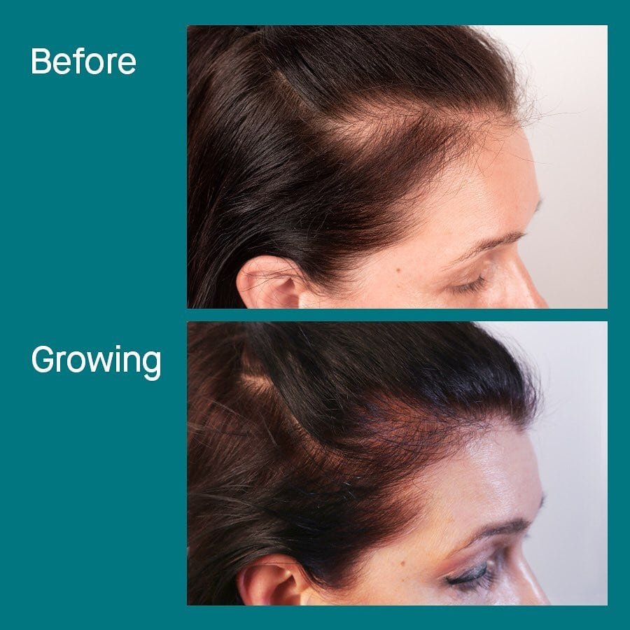 Nutrafol Hair Growth Result