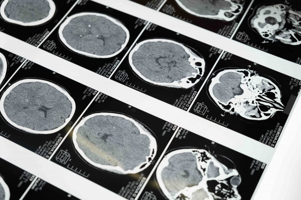 Nootropics For The Brain